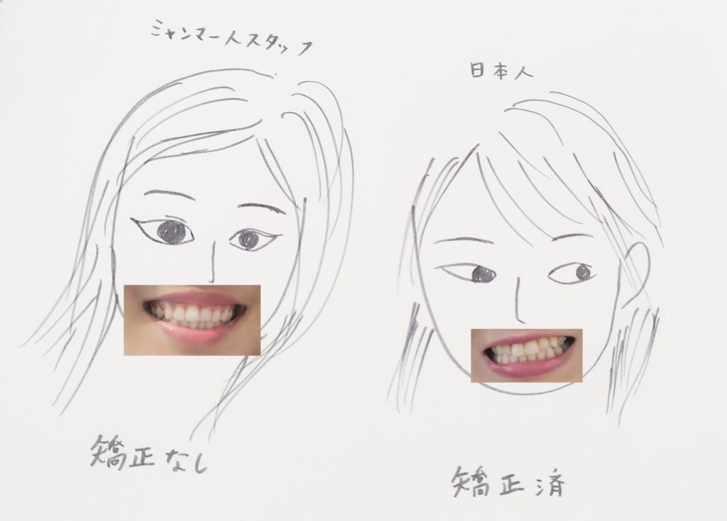 ミャンマー人（歯列矯正なし）と日本人（歯列矯正済）の歯並びの比較