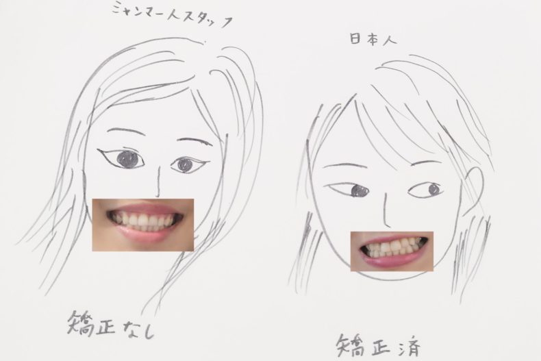 ミャンマー人（歯列矯正なし）と日本人（歯列矯正済）の歯並びの比較